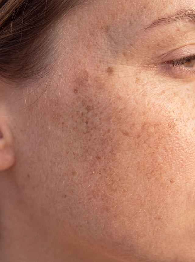 Dark Spots