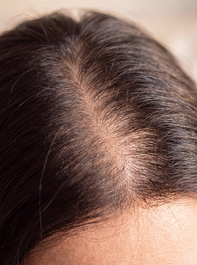 Hair Loss