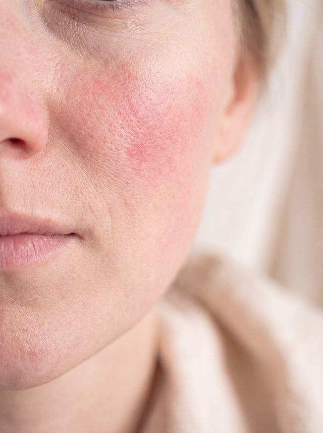 Redness & Sensitivity